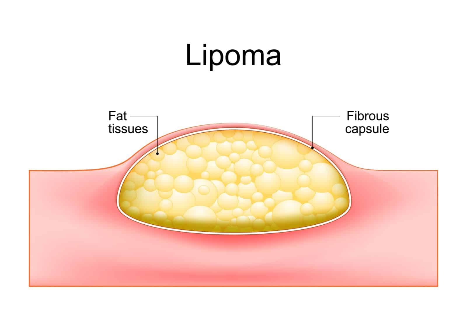 adipose tumors located into the subcutaneous tissues in the skin